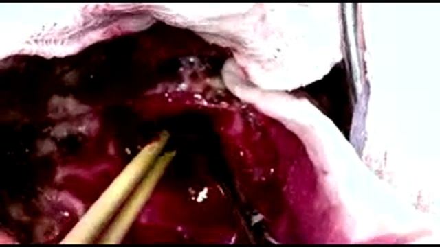 Recurrent Posterior Fossa Tumor смотреть онлайн
