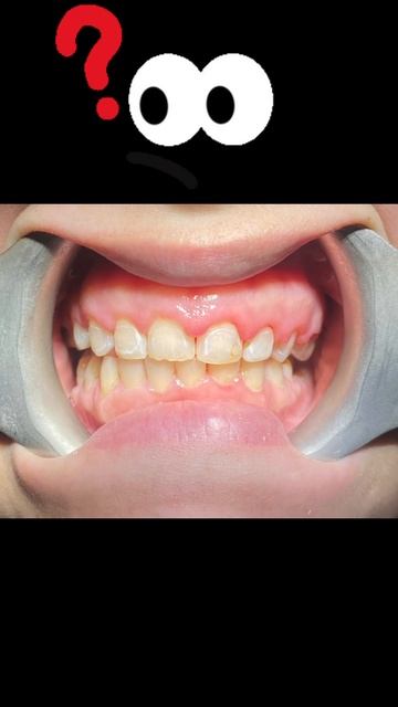 Orthodontics/metal braces/smile transformation/diastema,space closure treatment by Dr_Mirza_Muneeb смотреть онлайн
