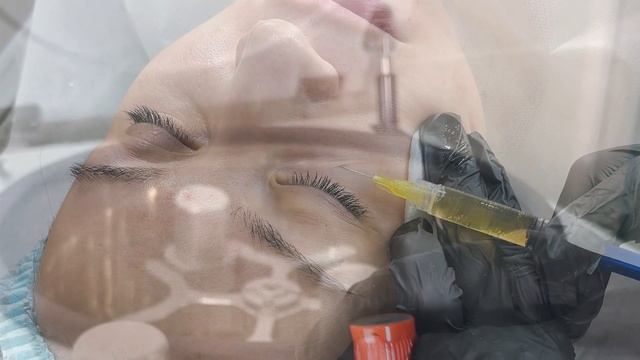 Плазмотерапия – восстановление и омоложение кожи с использованием собственных ресурсов организма смотреть онлайн