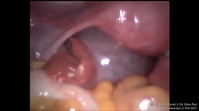 Torsion Adneksial me kist paraovarian смотреть онлайн