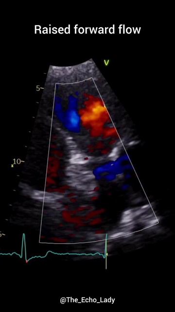 Pulmonary Stenosis! 🩵 #echocardiogram #echocardiography #cardiology #PulmonaryValve #congenital