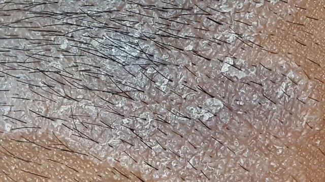 Tinea Corporis смотреть онлайн