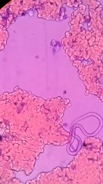 The filarial worm | Wuchereria bancrofti смотреть онлайн