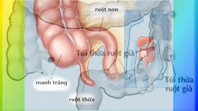 Viêm túi thừa: Nguyên nhân và cách điều trị смотреть онлайн