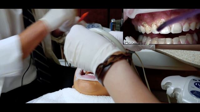 AMD LASERS Picasso Lite +