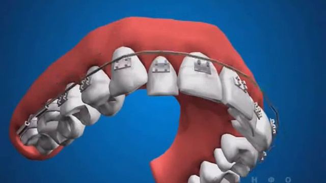 Брекеты смотреть онлайн