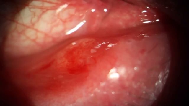Painful Pus Popped inside Eyelid Stye Infection смотреть онлайн