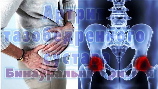 Артрит тазобедренного сустава