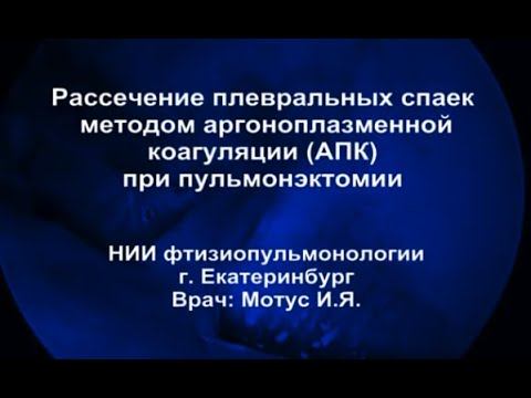 Рассечение плевральных спаек методом аргоноплазменной коагуляции при пульмонэктомии