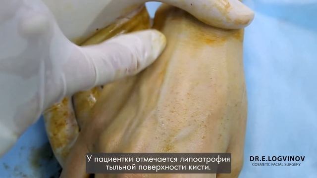 Липофилинг кистей Пластический хирург Евгений Логвинов смотреть онлайн