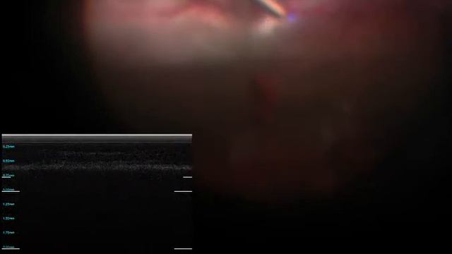 Micron: OCT A-scan with tremor canceling смотреть онлайн