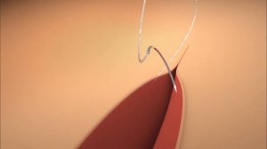 V-loc - технология безузлового шва