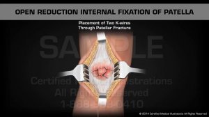 Открытая репозиция и остеосинтез надколенника спицами и проволочной петлей по Веберу