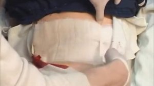 Проникающая травма живота