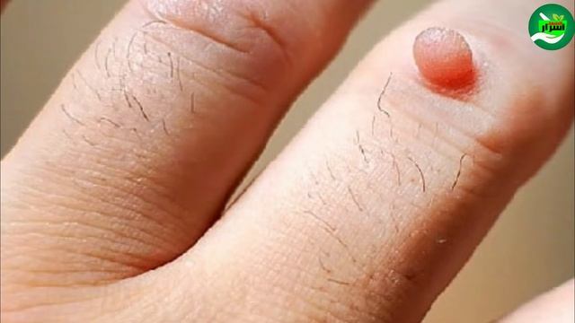 اسرع واقوى علاج لازالة الثآليل في الجسم والتخلص من الزوائد الجلدية - علاج فعال بعشبة واحدة فقط
