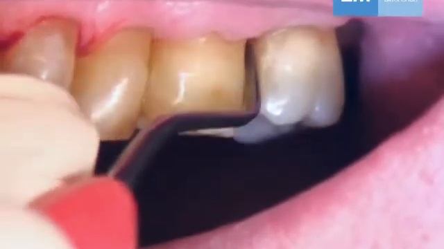 LM 156-157 - скейлер-мотыга для мезиально-дистальных поверхностей | LM-Instruments Oy (Финляндия) смотреть онлайн