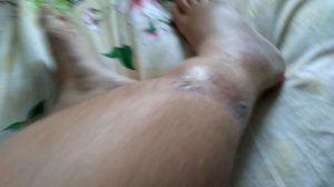 открытый перелом голени через 2 мес 3 операции