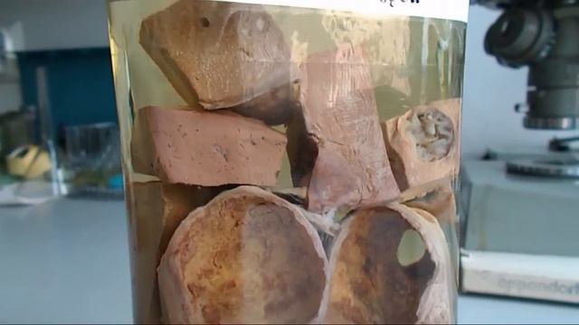 Echinococcus granulosus - Hydatid Disease - Tasiemiec bąblowcowy смотреть онлайн