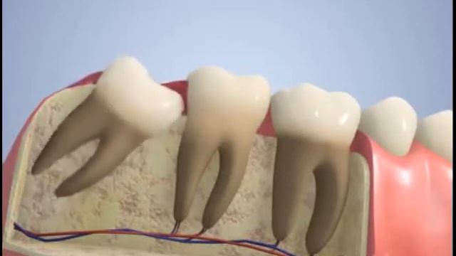 Когда удалять "зуб мудрости" смотреть онлайн