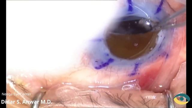 PKP, synechilolysis, IOL implantation and pupiloplasty (local anesthesia) by Didar S. Anwar M.D. смотреть онлайн