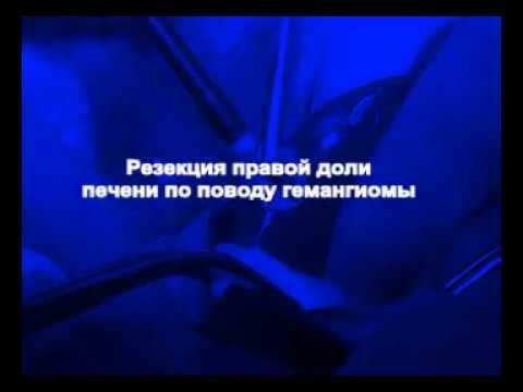 Резекция правой доли печени по поводу гемангиомы с использованием аргоноплазменной коагуляции