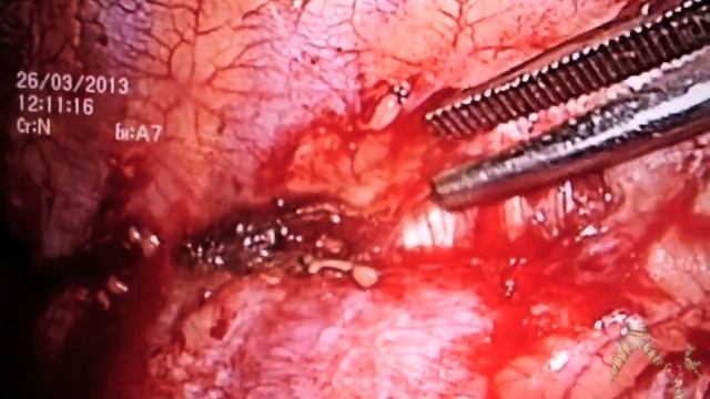 VTS parietal pleurectomy and lung resection (Dmitry Bazarov) смотреть онлайн