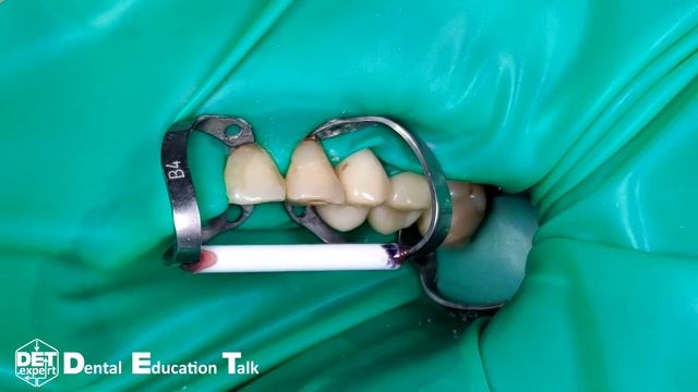 Изоляция шеек 22 и 23 при помощи B4 с фиксацией микробрашем DET.expert & Sanctuary 4K смотреть онлайн