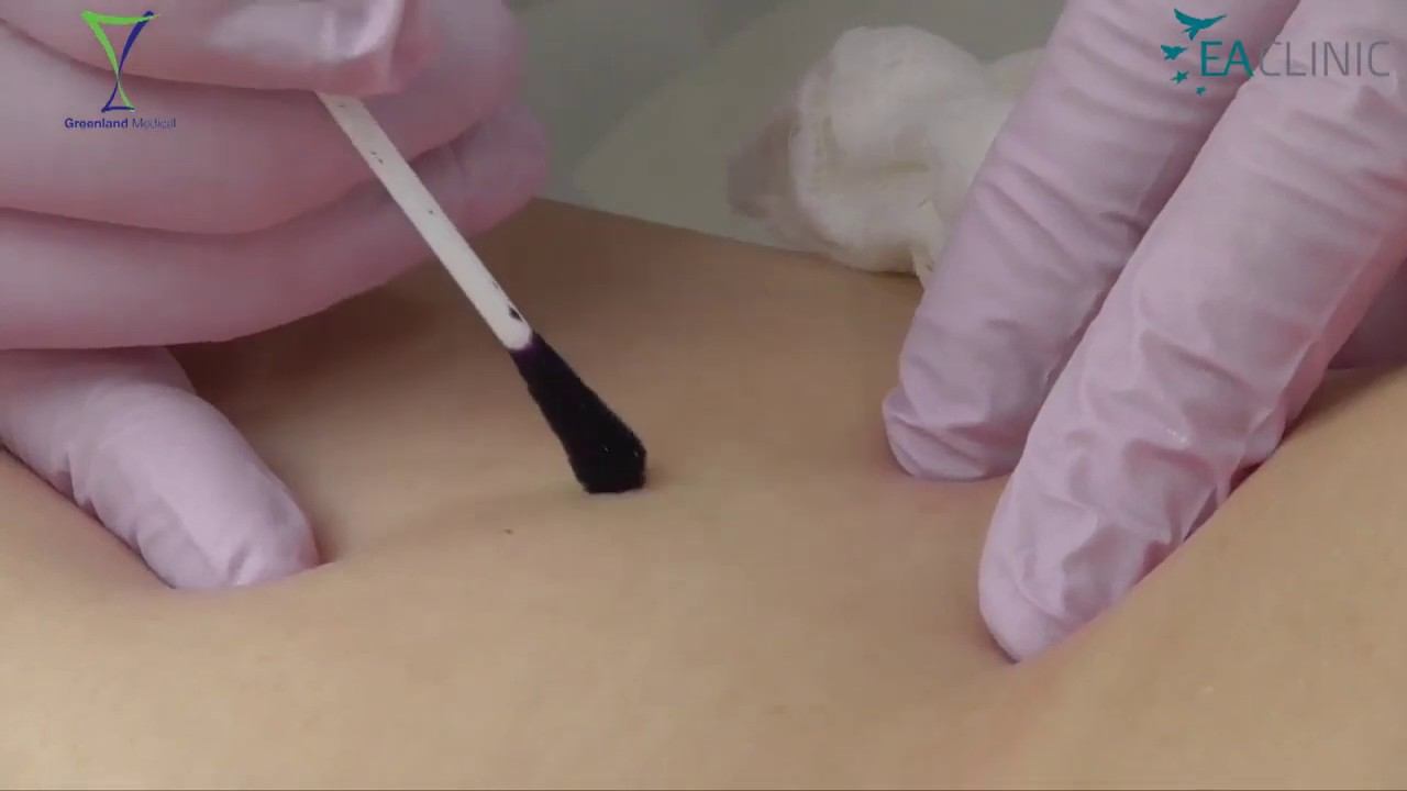 Удаление невуса на радиоволновом аппарате Greenland Medical RFS 3800K