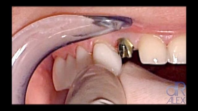 Dental Implants Procedure in Midtown NYC - Dr. Alex Rubinov - Cosmetic Dentist in NYC смотреть онлайн