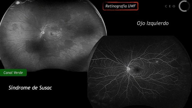 Multi CEO - Síndrome de Susac смотреть онлайн
