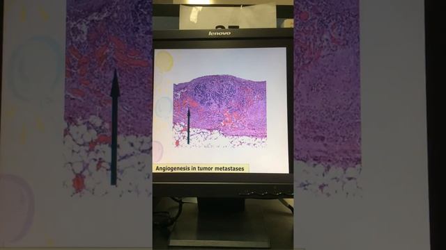 Pathology Lab #08: Neoplasia III cases смотреть онлайн