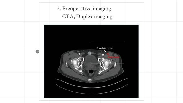 Jp Hong lecture series on SCIP (Superficial Circumflex Iliac Artery Perforator) flap смотреть онлайн