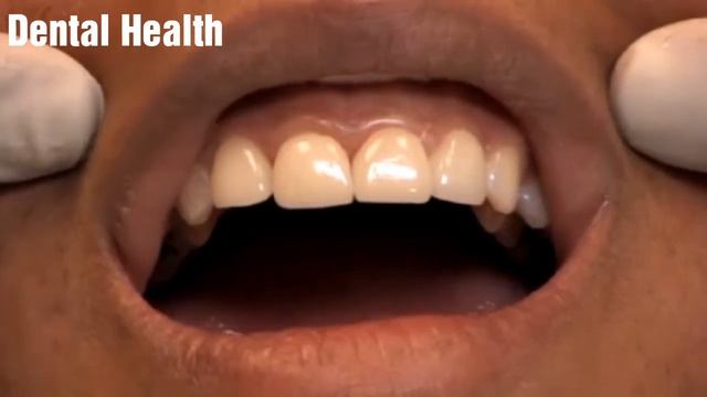 Dental Veneer смотреть онлайн