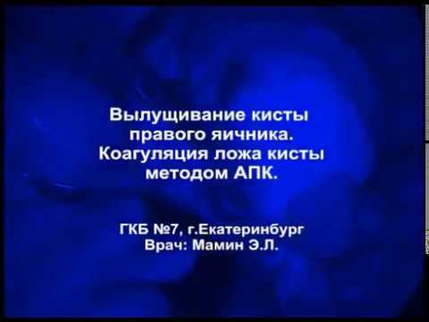 Вылущивание кисты правого яичника