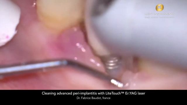 Чистка запущенного периимплантита с помощью лазера LiteTouch™ Er:YAG