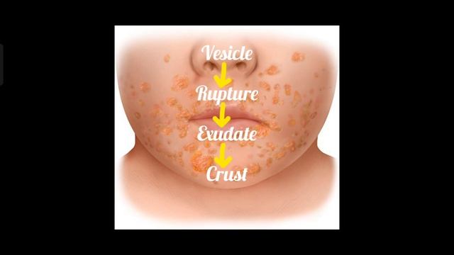 Impetigo||dermatology @TheAyurpathy