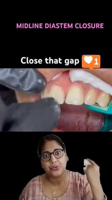 MIDLINE DIASTEMA CLOSER | COMPOSITE RESTORATION | #shortsfeed #dentalesthetics #youtubeshorts #vir смотреть онлайн