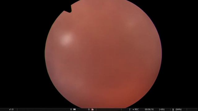 рак шейки матки#cancer Cervix Uteri#vaginoscopy# Hysteroscopy#diagnostic Cancer# Biopsy#