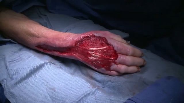 Treating Infected Burn Wound Part 2 смотреть онлайн