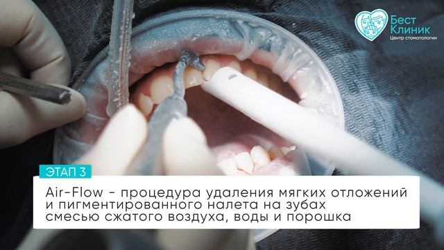 Профессиональная гигиена полости рта в Бест Клиник