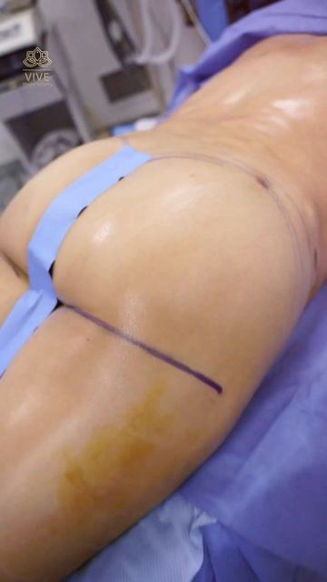 Contours of Confidence🤩Colombian Lipo🍑 by Dr Padilla-Vive Plastic Surgery💖 in #tijuana смотреть онлайн