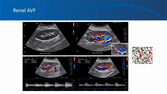 Renal ultrasound video 9, University of Florida Nephrology, Introduction to Doppler ultrasonography смотреть онлайн