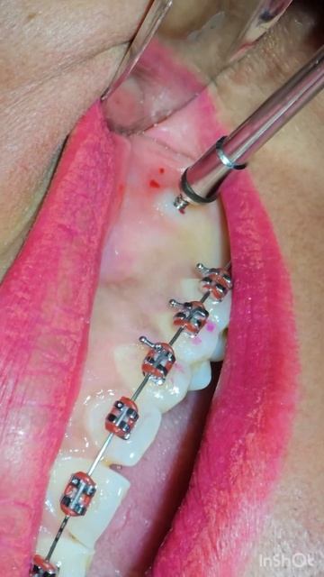 Mini screw #ارتودنسی #دندانپزشکی #سلامتی با دکتر اعتمادی #مینی اسکرو смотреть онлайн