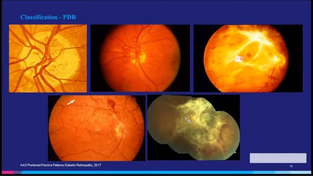 Retinal Imaging and Management of Diabetic Retinopathy смотреть онлайн