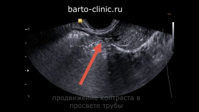 Эхогсг - гистеросальпингография