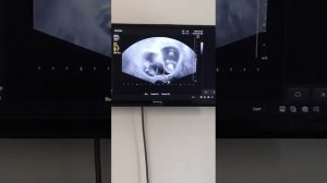 УЗИ ЭКО двойни//Сердцебиение