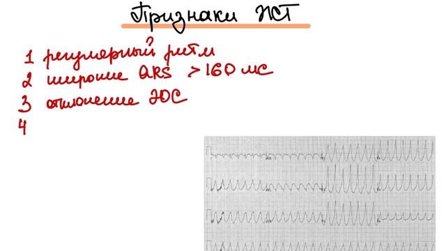 Желудочковая тахикардия. Как распознать? Как отличить от наджелудочковой тахикардии?