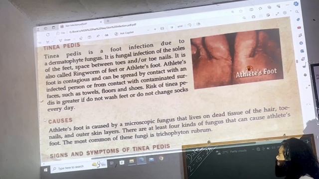 Tinea Pedis | Athlete’s Foot | Fungal Infection | Skin Disease #tinea #skincare #skindiseases #skin смотреть онлайн
