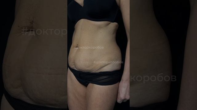 Абдоминопластика с переносом пупка + липосакция живота смотреть онлайн