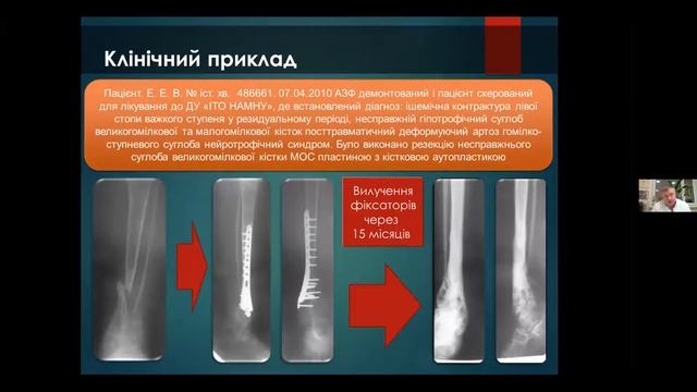 Вебінар - Діагностика і лікування переломів та їх наслідків в умовах посттравматичної ішемії смотреть онлайн